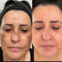 کرم ضد لک و فوق ابرسان پوست