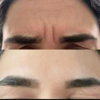 فیلربادی و انجام انواع خدمات زیبایی پوست ومو