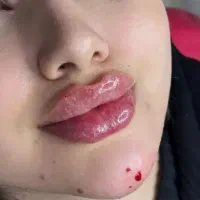 بوتاکس ژل و مزوتراپی با تخفیف ویژه