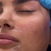 مدل ژل بوتاکس