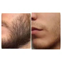 درمان گم پشتی ریش و سبیل