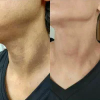 بمب روشنی پوست