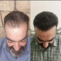 کاشت مو vip|خدمات آرایشگری و زیبایی|سنندج, |دیوار