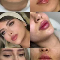 خدمات تخصصی ژل و بوتاکس جشنواره نصف قیمت