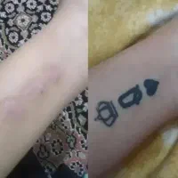 پاک کردن تتو یک جلسه ای