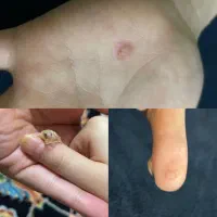 حذف و درمان ریشه‌ای 14 روزه HPV/اچ‌اس‌وی