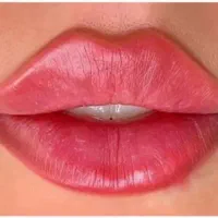 جشنواره ژل و بوتاکس ۳۰درصد تخفیف