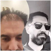 کاشت تخصصی مو /ابرو شیرازی vip