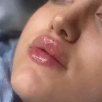 ژل لب ، چانه ، گونه ، زاویه فک و بوتاکس ، آنزیم
