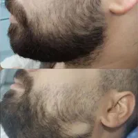 درمان تضمینی ریزش سکه‌ای مو و ریش فقط یک جلسه