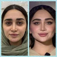 ژل و بوتاکس ،فول فیس آفر ۷ روزه فقط ۱۱میلیون