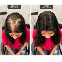 پک معجزه اسا ضدریزش و رویش مجدد مو جایگزین کاشت