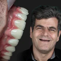 ایمپلنت‌اقساطی‌ویژه‌(به مدت‌محدود)