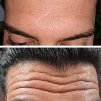تزریق فیلر ژل و بوتاکس و آنزیم