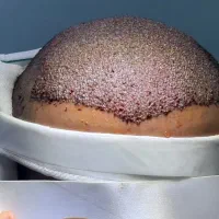 آموزش کاشت مو و انجام کاشت مو