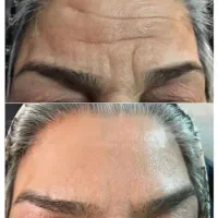 بیوممتیک راه جوانسازی و رفع لک