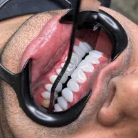 دندوناتو سفید کن