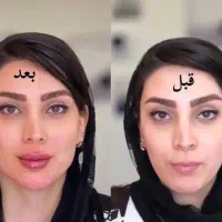 بلفاروپلاستی توسط پزشک