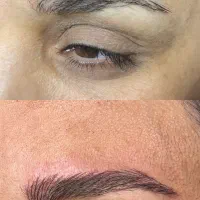 مدل میکروبلیدینگ