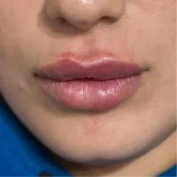 تزریق فیلر سی سی یک ملیون