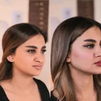 کلینیک تخصصی پوست هایفو ژل نخ آموزش حرفه ای ژل نخ