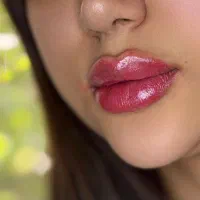 ژل و بوتاکس  بوتاکس چشم گربه ای رایگان