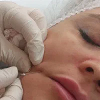 ژل و بوتاکس