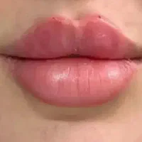 تزریق ژل و بوتاکس