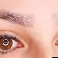 ریمو تخصصی و رفع کبودی لب