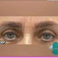 بلفاروپلاستی،لیپو غبغب،اتوپلاستی،لیپوابدو،مامو