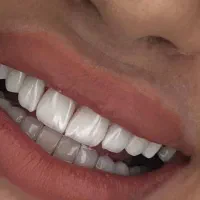 کامپوزیت دندان/نقد و اقساط/یک جلسه
