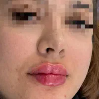 تزریق فیلر۹۸۰ بوتاکس750، لابیاپلاستی تااخر هفته