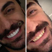 کلینیک تخصصی کامپوزیت دندان تمام اقساط در شیراز