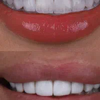 مدل برای کامپوزیت دندان