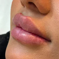 پاکسازی پوست فیشال آبرسانی جوانسازی صورت