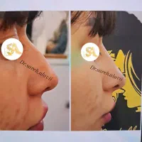 اصلاح فرم بینی بدون جراحی توسط پزشک