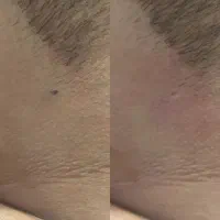 انواع خال برداری فقط برای بانوان