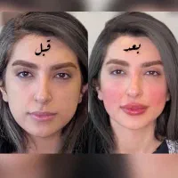 تخفیف تزریق فیلر