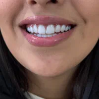 کامپوزیت و کاشت دندان با بهترین متریال و قیمت|خدمات آرایشگری و زیبایی|ساری, |دیوار