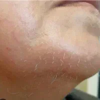 الکترولیز موهای زائد
