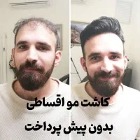 جشنواره کاشت مو قسطی 3تومن
