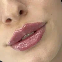 تزریق ژل و بوتاکس و لیزر توسط پزشک