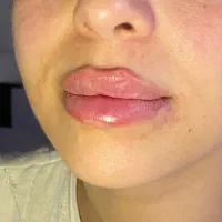 ژل،بوتاکس،لیزر مطب صدف(رویال سابق)