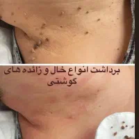 برداشت خال و اسکین تگ بدون درد