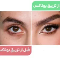 مدل برای بوتاکس