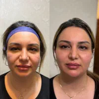 تزریق چربی وفیلر لابیاپلاستی وغبغب ژل لب هیپ دیپ