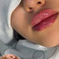 تزریق ژل وبوتاکس وفیلر