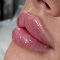 لیزر کندلا، ژل بوتاکس ، کانتورینگ، لیزر تیتانیوم