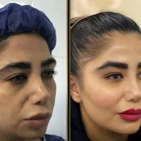 تزریق چربی صورت