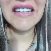 کامپوزیت فکی ۱۲